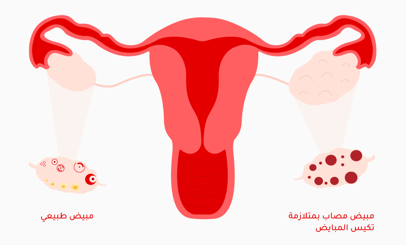 تكيس المبايض: الأسباب والأعراض وخيارات العلاج