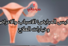 تكيس المبايض: الاسباب والاعراض وخيارات العلاج