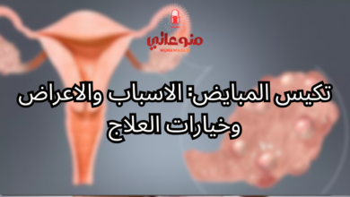 تكيس المبايض: الاسباب والاعراض وخيارات العلاج