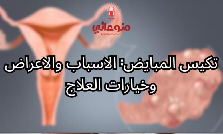 تكيس المبايض: الاسباب والاعراض وخيارات العلاج